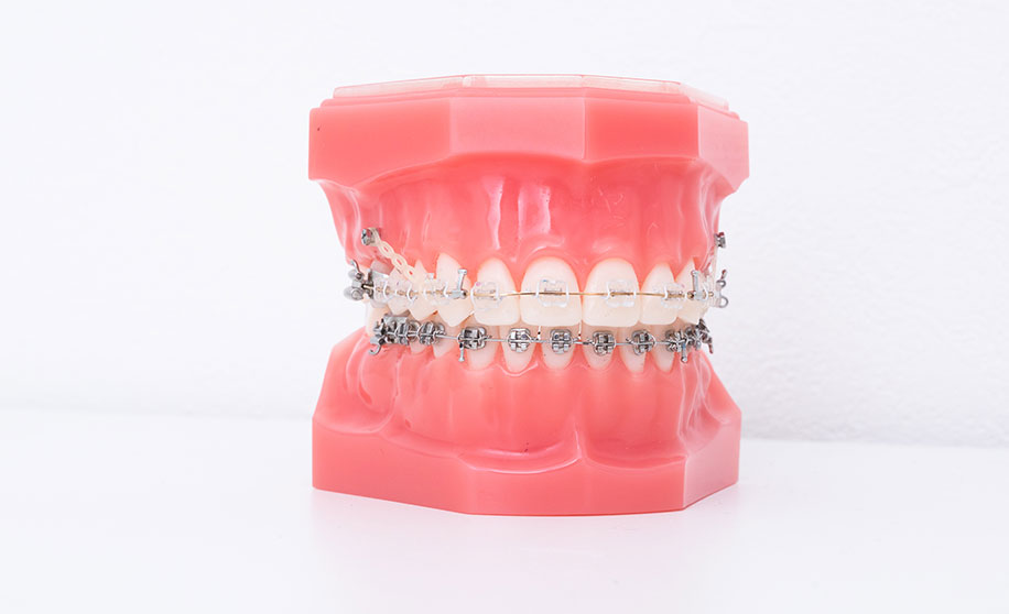 歯科矯正用アンカースクリューによる治療